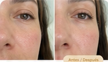 Antes y después: rejuvenecimiento facial natural